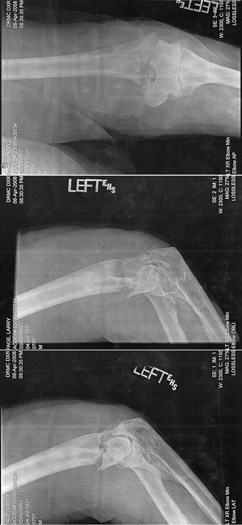 The Elbow photo 2